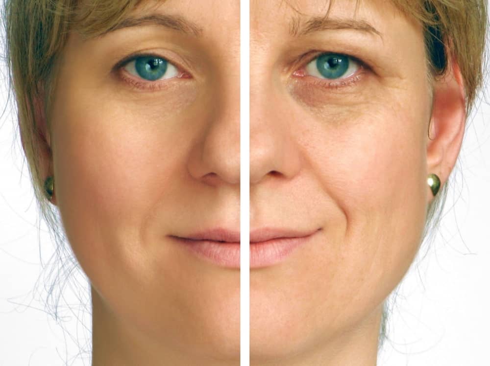 what-s-the-difference-between-a-mini-face-lift-and-a-regular-face-lift